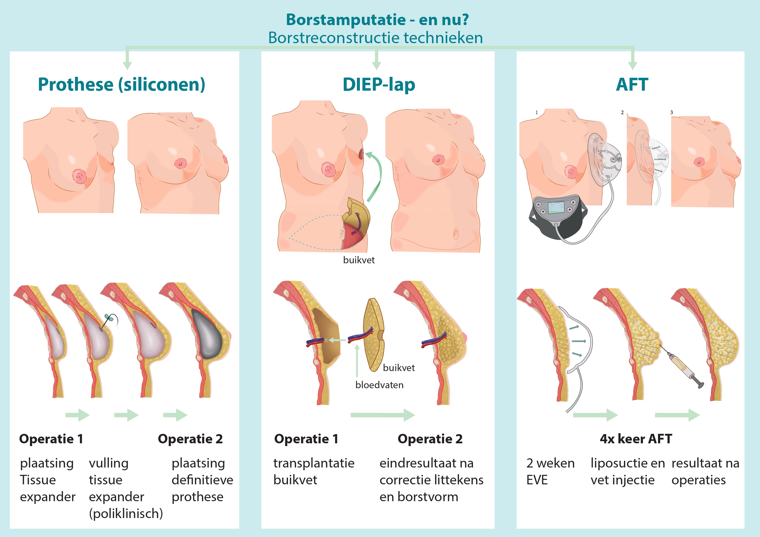 Borst amputatie en nu?