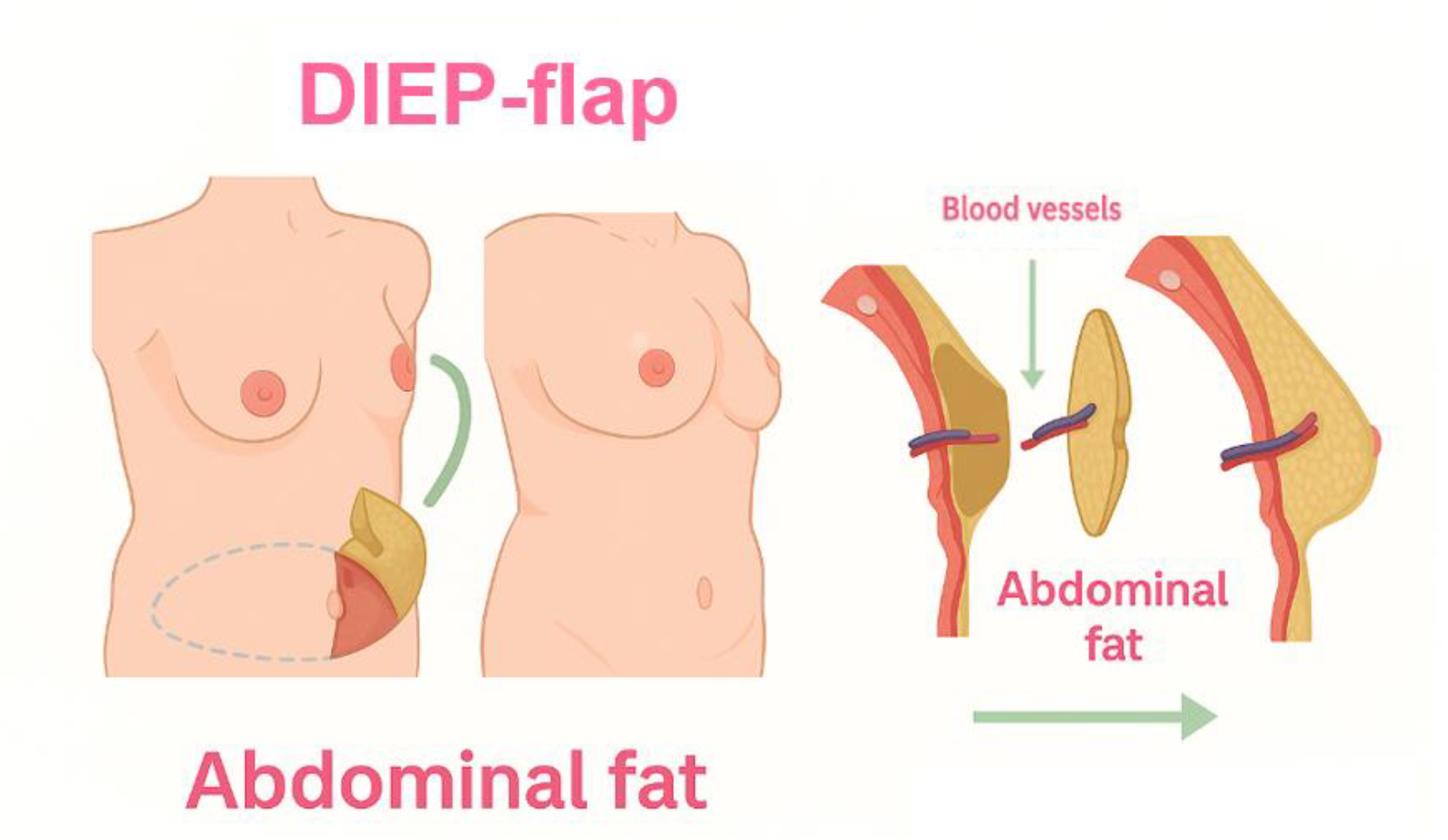DIEP lap