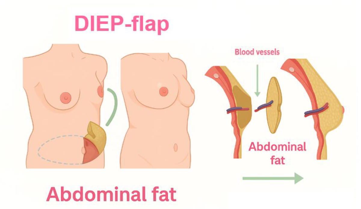DIEP lap